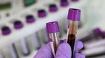 Un test de sânge ar putea prezice dacă adulții sănătoși sunt predispuși la Alzheimer