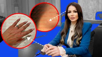 Exclusiv Primele imagini cu urmările agresiunii asupra senatoarei POT. Valentina Aldea are nevoie de 2-3 zile de îngrijiri medicale după ce a fost atacată cu o bară din metal | GALERIE FOTO