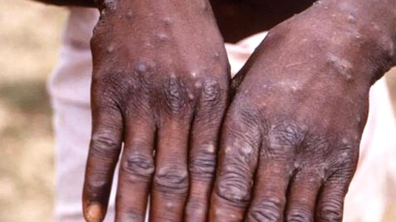 A fost confirmat primul caz de variola maimuţei în afara Africii. În ce ţară europeană a fost depistat