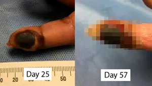FOTO | Experiment cu final cum nu se poate mai prost: Degetul unei femei a început să putrezească, după ce s-a infectat accidental cu un virus