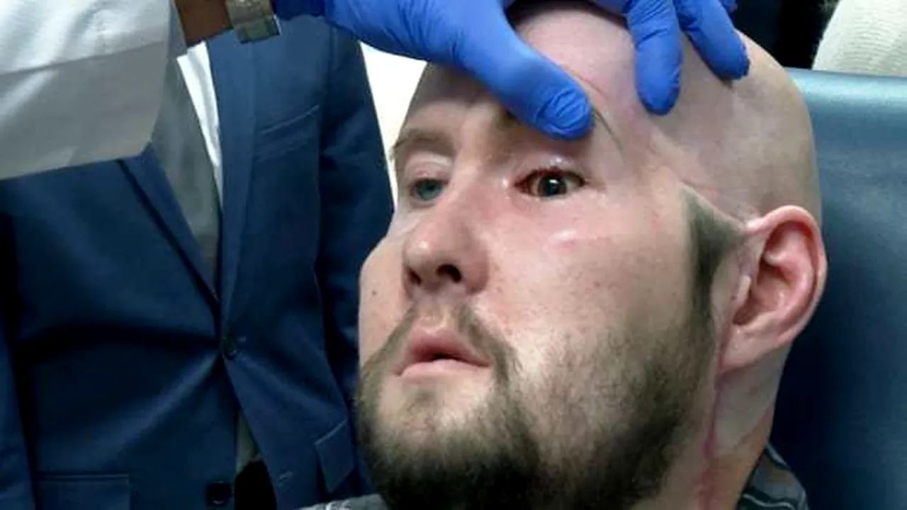 Premieră medicală: Chirurgii au efectuat primul transplant de glob ocular uman din lume la New York