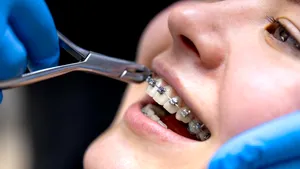 Cum îți influențează sănătatea generală o dantură perfect aliniată (P)