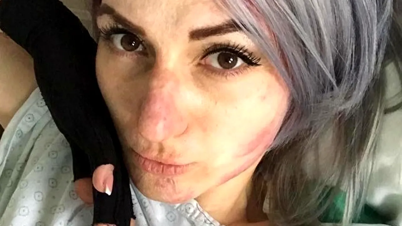 Colectiv, 3 ani. Adina Apostol, supravieţuitoare: Sunt internată, asta spune multe cred. Fac operaţii, bandaje... Este foarte obositor