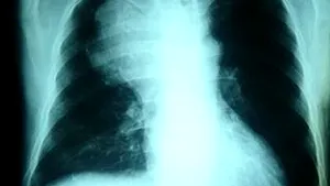 Predispoziţia genetică vinovată de apariţia cancerului pulmonar, identificată de cercetători