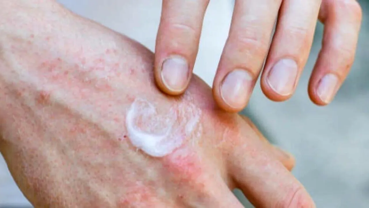 Stresul agravează eczemele: mecanismul din spatele inflamației pielii