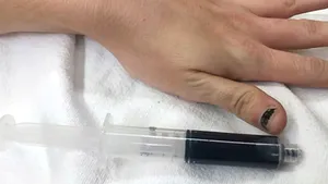 Caz confirmat de „sânge albastru”: Cum au diagnosticat medicii o tânără, care s-a prezentat cu simptome neobişnuite la spital