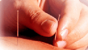 Acupunctura poate creşte rata de succes a fecundării in vitro