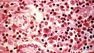 O fetiţă din Australia şi-a schimbat grupa sanguină după un transplant de ficat