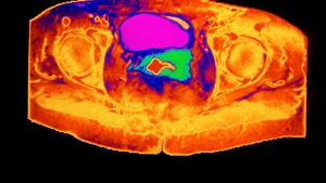 Cancerul de col uterin ar putea fi eradicat în Anglia. Măsurile care au contribuit la reuşita autorităţile britanice