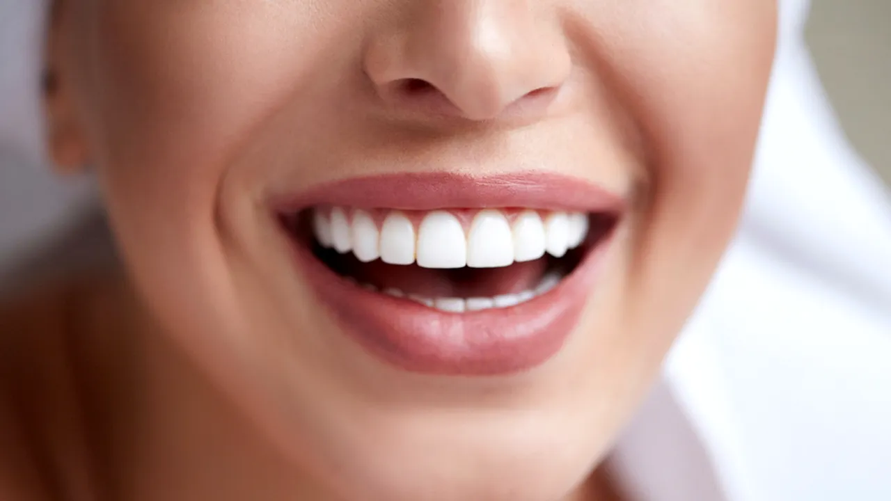 Implanturi dentare sau faţete dentare: Ce tip de lucrare alegem pentru un zâmbet perfect?