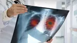 Un medicament revoluţionar reduce tumorile pulmonare. 77% dintre pacienţi au avut rezultate pozitive