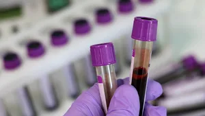 Un test de sânge ar putea prezice dacă adulții sănătoși sunt predispuși la Alzheimer