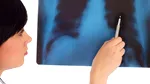 Radiografiile toracice ajută la depistarea timpurie a cancerului pulmonar