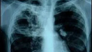 O treime din populaţia României este infectată cu microbul tuberculozei