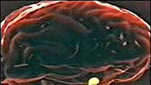 Litiul are efecte benefice asupra pacienţilor atinşi de maladiile neuromotorii