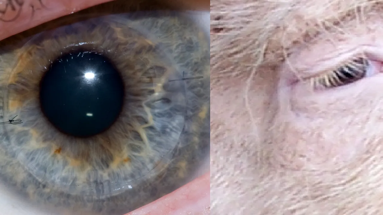 Un implant ocular revoluţionar din colagen de porc a redat vederea la 14 nevăzători