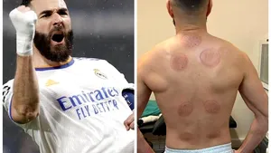 Tratamentul cu ventuze îi poate aduce unui fotbalist Balonul de Aur