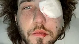 SUA. Un tânăr a rămas fără un ochi după ce a fost lovit de o grenadă, în timpul protestelor