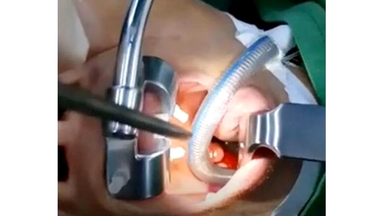 O femeie se plângea de migrene. Când au operat-o, medicii au găsit ceva total neaşteptat în sinusuri | VIDEO