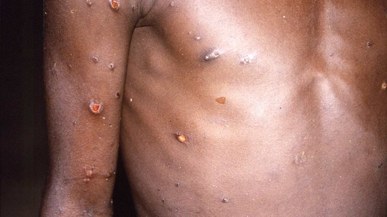 Primul caz de mpox Clade 1b detectat în Regatul Unit