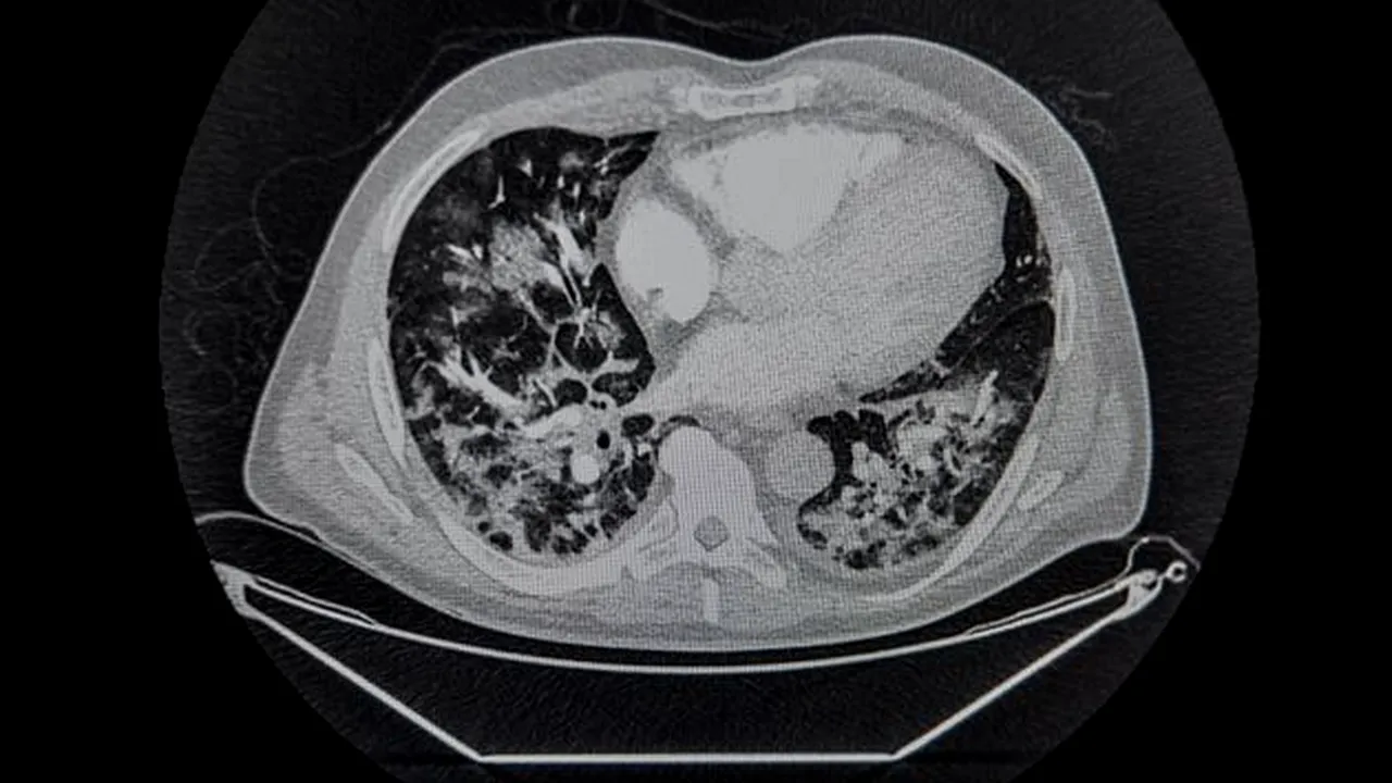 Descoperirea unui medic francez despre Covid-19. A analizat peste 2.500 de radiografii toracice