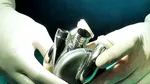 Un australian a supravieţuit 100 de zile cu o inimă artificială