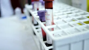 Românii pot beneficia de un nou tratament pentru artroză