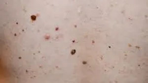 Oamenii сu aluniţe trăiesc mai mult