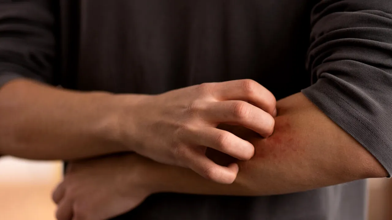 Înțepăturile de insecte: cum le recunoști, ce trebuie să faci și când trebuie să mergi de urgență la medic