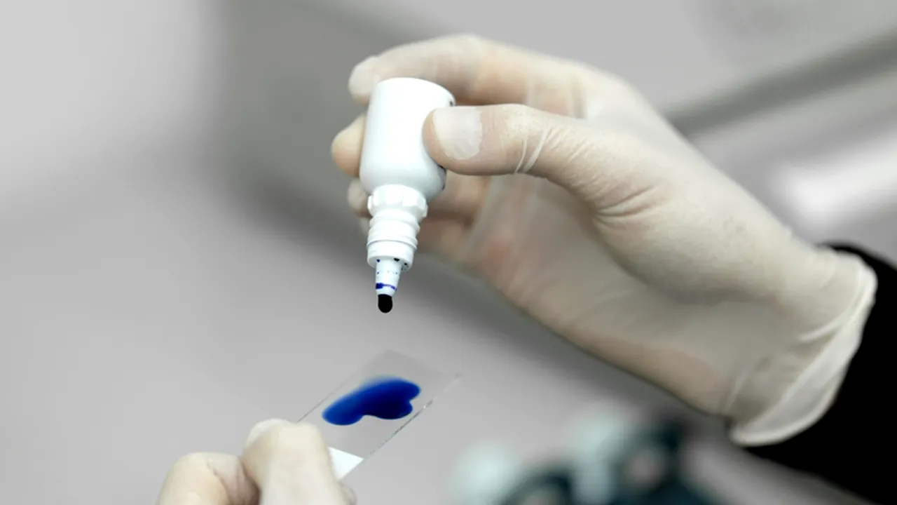 Un test de sânge revoluționar detectează cancerul de cap și gât HPV cu 10 ani înainte de simptome