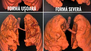 CNCAV a publicat tomografiile computerizate a 4 pacienţi nevaccinaţi, bolnavi de COVID-19