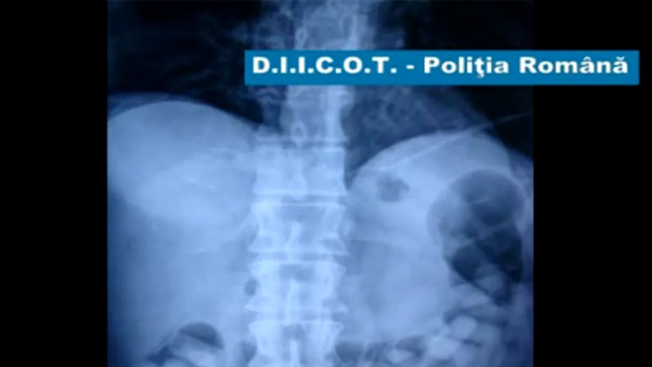 Un bulgar a înghiţit un kilogram de cocaină. Vezi aici radiografia