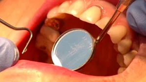 Igiena dentară necorespunzătoare ar putea avea legătură cu bolile de inimă