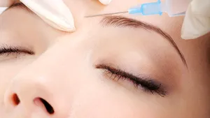 Tratament cu acid hialuronic pentru umplerea ridurilor faciale. Efect instantaneu după prima injectare