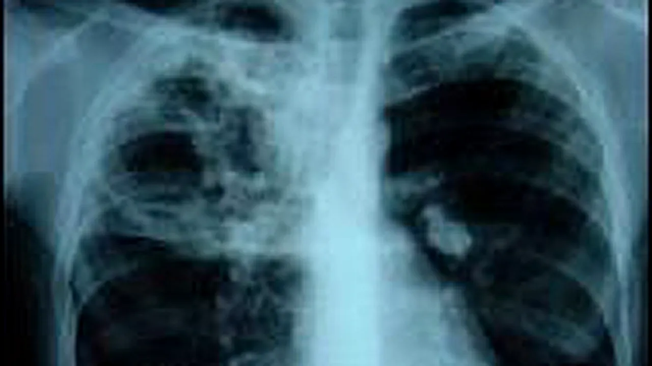 O treime din populaţia României este infectată cu microbul tuberculozei
