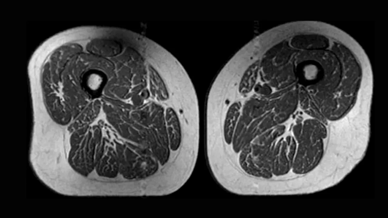 Alimentele ultraprocesate „transformă” mușchii în grăsime: semnal de alarmă dintr-un nou studiu