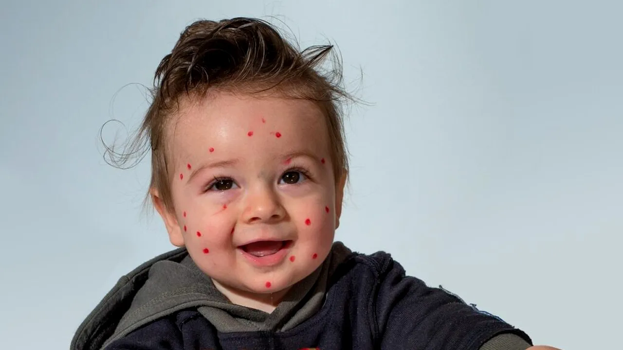Vaccinarea împotriva varicelei devine obligatorie în Bulgaria