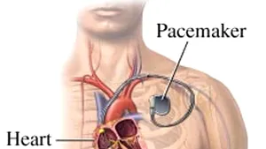 Pacemakerele şi defibrilatoarele cardiace, vulnerabile la pirateria informatică