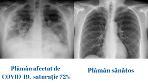 CNCAV: Cum arată un plămân afectat de COVID-19 faţă de un plămân sănătos