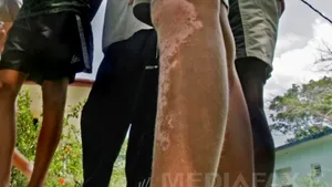 S-a descoperit un posibil remediu pentru vitiligo