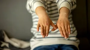Virusolog: Rujeola poate cauza daune permanente sistemului imunitar și creierului