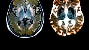 Cum poate afecta coronavirusul creierul. Anunţul unor medici din Statele Unite