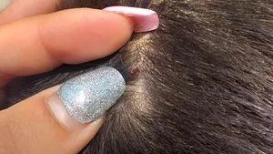 Sezonul căpuşelor. Explicaţiile medicului Tudor Ciuhodaru: cum să ne protejăm şi ce trebuie să facem în cazul în care am fost muşcaţi