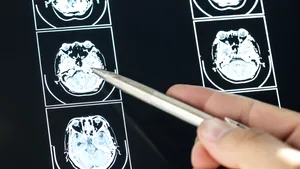 M-am întors din India cu 38 de paraziți în creier. Cum s-a infectat o femeie de 42 de ani fără să mănânce carne