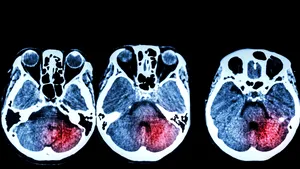 Zilele care îţi salvează viaţa. Cu cât timp înainte apar semnele unui accident vascular cerebral 