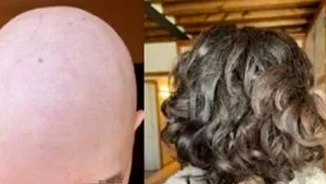 Medicamentul împotriva căderii părului care a ajutat-o pe o tânără de 17 ani să-şi recupereze podoaba capilară

