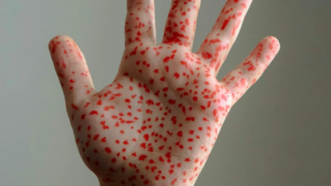 Canada își pierde statutul de țară fără rujeolă, după trei decenii