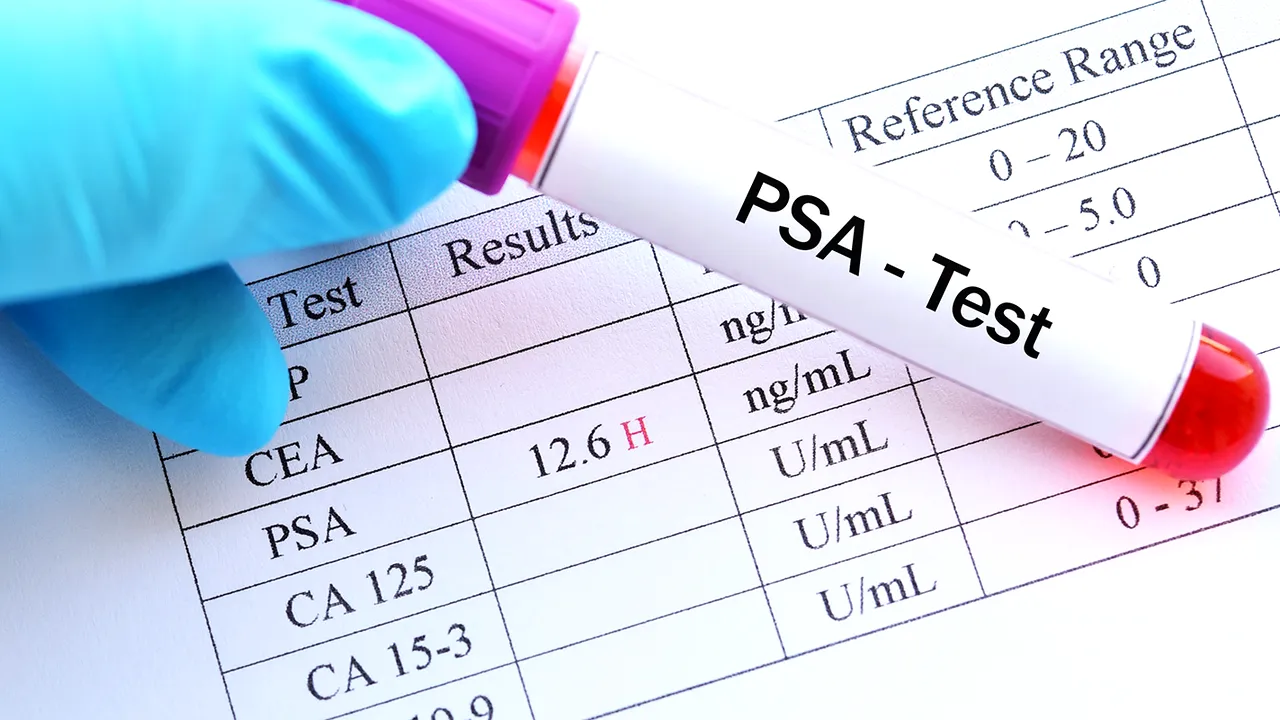 S-ar salva mii de vieţi, anual, cu testul PSA la bărbaţi (de prostată), singurul marker folosit în diagnostic