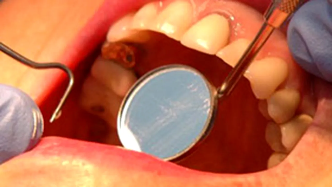 Igiena dentară necorespunzătoare ar putea avea legătură cu bolile de inimă