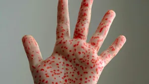 Focar de rujeolă în nordul Londrei: Peste 60 de copii s-au infectat